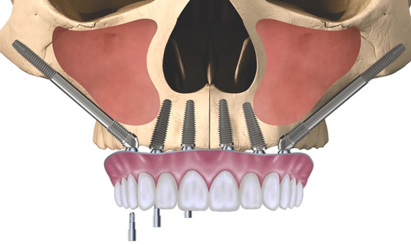Kỹ thuật Implant Zygomatic hiện đại hiện nay