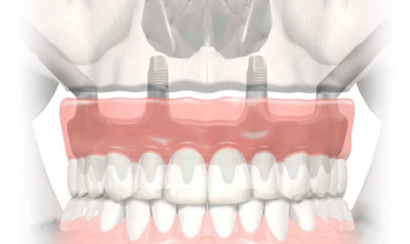 Phục hình Implant Zygomatic 