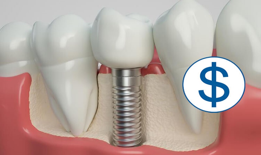 Tổng chi phí trồng răng Implant hiện nay có cao không?