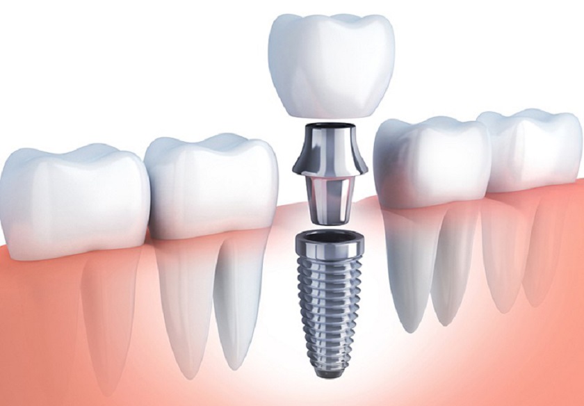 Tổng chi phí trồng răng Implant phụ thuộc phần lớn vào vật liệu cấy ghép