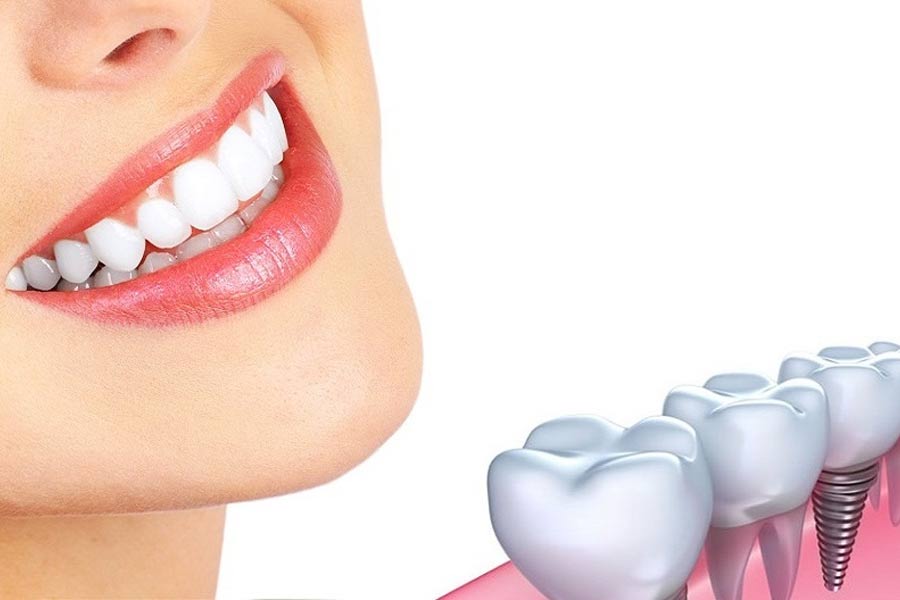 Trồng răng Implant - khôi phục toàn diện răng đã mất