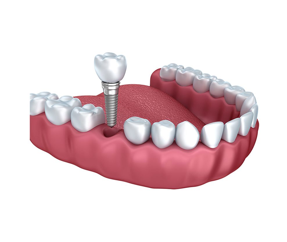 Cắm Implant không gây xâm lấn tới các răng thật bên cạnh