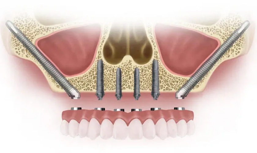 Implant Zygomatic bám vào xương má chứ không phải xương hàm trên