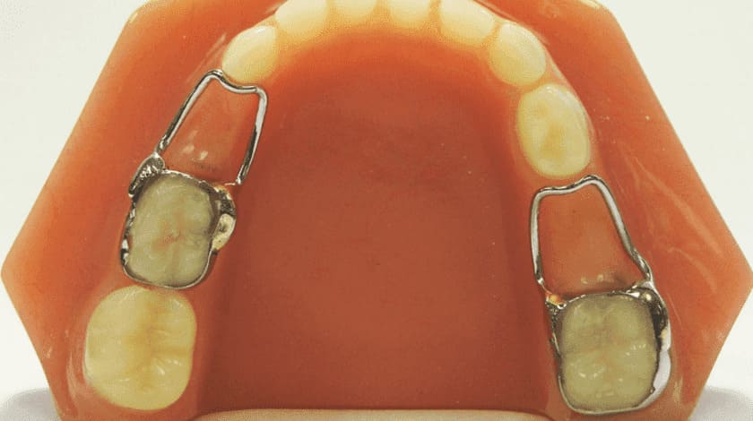 Hàm giữ khoảng là phương án điều trị phù hợp hơn tình trạng mất răng ở trẻ em