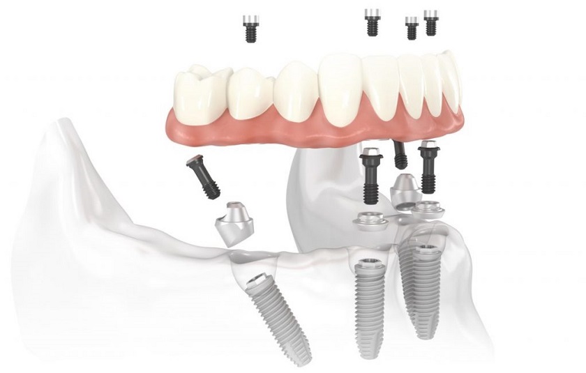 Kỹ thuật cấy ghép Implant