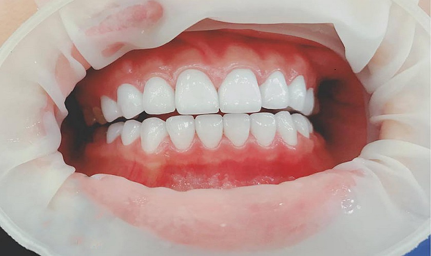 Kỹ thuật phục hình răng sứ