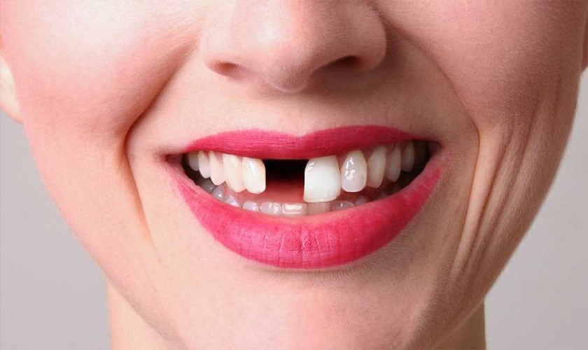 Trồng răng cửa giá bao nhiêu?