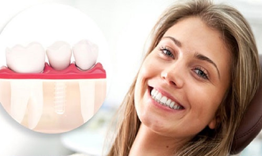 Trồng răng Implant bao lâu chịu ảnh hưởng từ yếu tố nào?