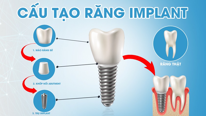 Cấu tạo tương tự răng thật của răng Implant