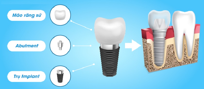 Cấu tạo hoàn chỉnh gồm 3 phần của răng Implant