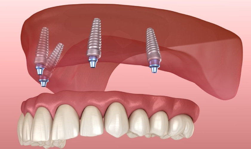 Trồng răng Implant All on 4