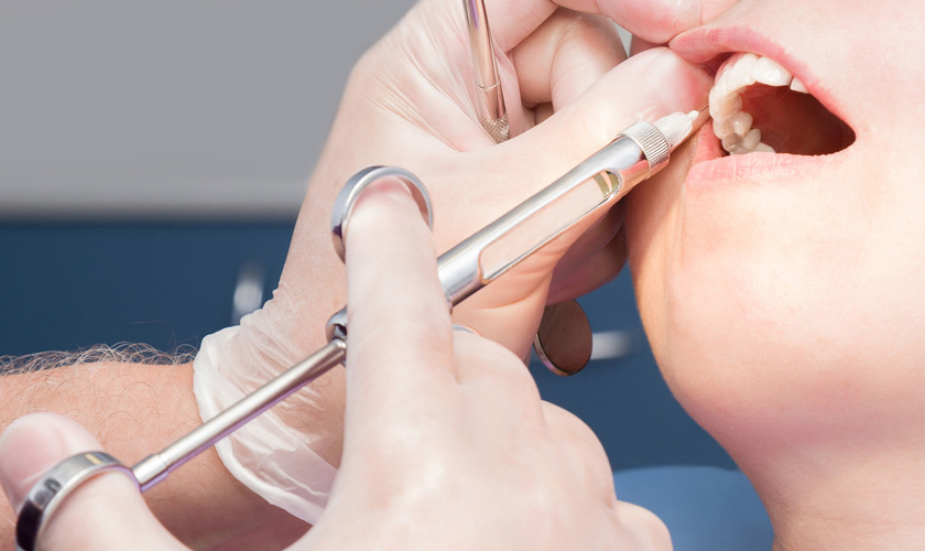 Vệ sinh răng miệng và gây tê vùng răng cửa cần điều trị