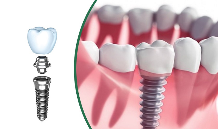 Kỹ thuật trồng răng Implant