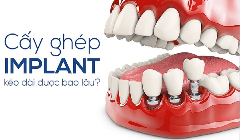 Trồng răng Implant được bao lâu thì phải thay mới?