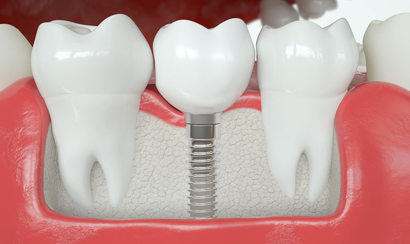 Trồng răng Implant là gì? Giá bao nhiêu tiền?