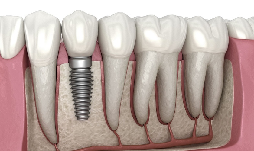 Trồng răng implant ở đâu tốt?