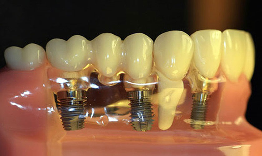 Chi phí trồng răng implant</strong> Pháp tùy thuộc vào nhiều yếu tố