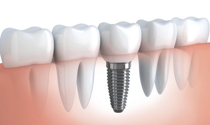 Trồng răng implant số 7 - Giải pháp thay thế răng hiệu quả