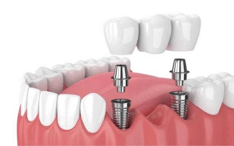 Trồng răng Implant dùng được bao lâu?