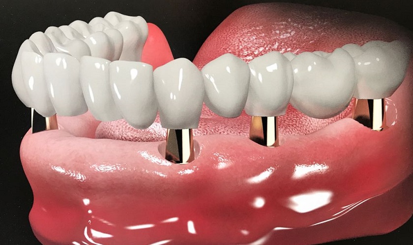 Trồng răng implant toàn hàm giá bao nhiêu? Có ưu điểm gì?