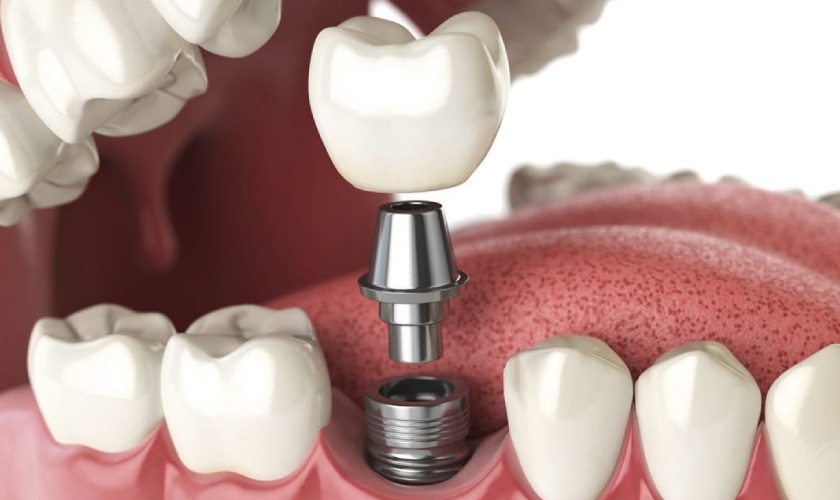 Phương pháp cấy ghép Implant