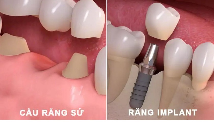 Chi phí trồng răng Implant sẽ cao hơn so với cầu răng sứ