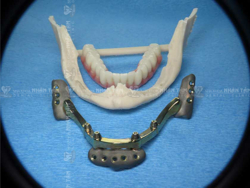 Cấy ghép Implant dưới màng xương là kỹ thuật mới tại Việt Nam