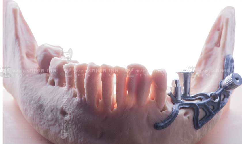 Phương pháp này phù hợp với bệnh nhân bị tiêu xương hàm đặc biệt nghiêm trọng