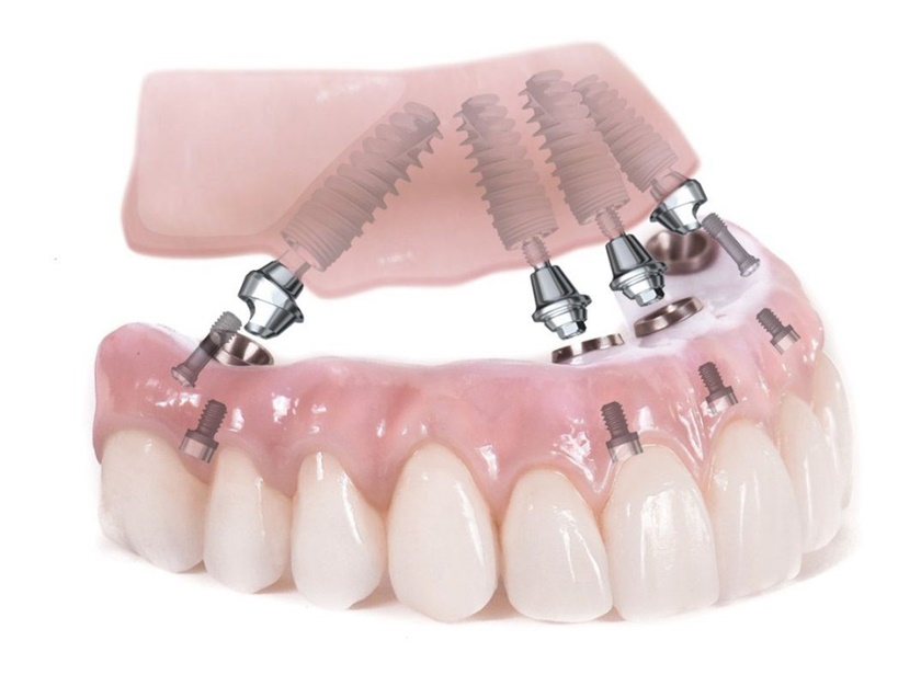 Cấy ghép răng Implant All on X