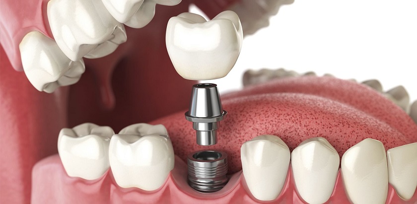 Trụ implant có độ tương thích sinh học cao, an toàn cho cơ thể
