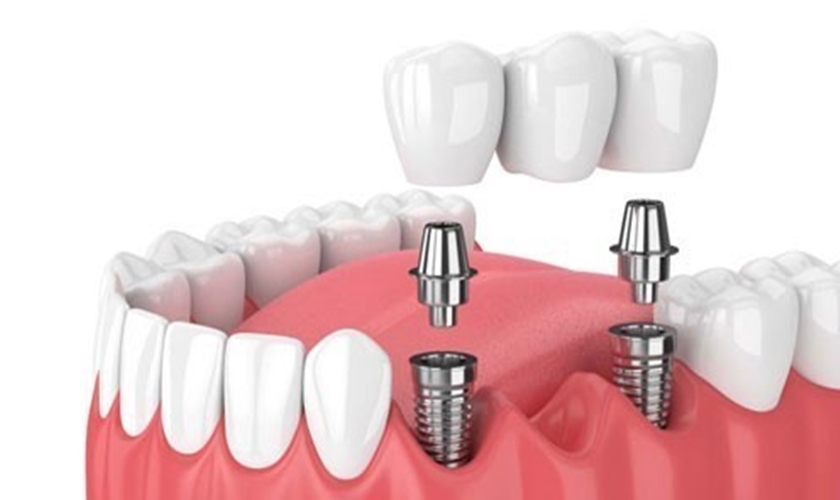 Trồng răng Implant nha khoa có nhiều ưu điểm