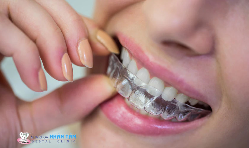 Niềng răng trong suốt Invisalign tại Nha Khoa Nhân Tâm