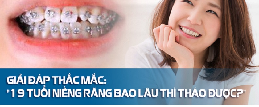 Giai đoạn 19 tuổi niềng răng bao lâu mới hoàn tất