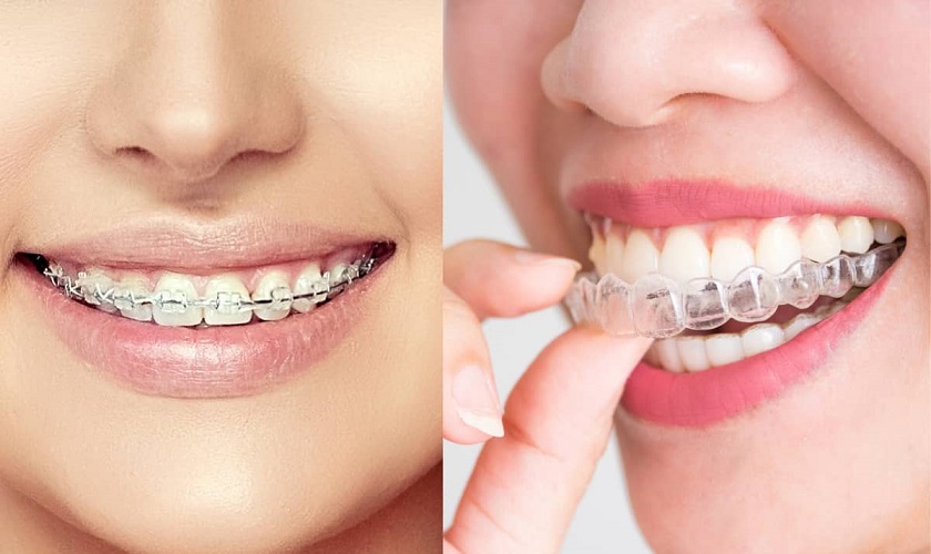 Có những biến đổi diễn ra trong quá trình niềng răng ở tuổi 19 có thể cần lưu ý?
