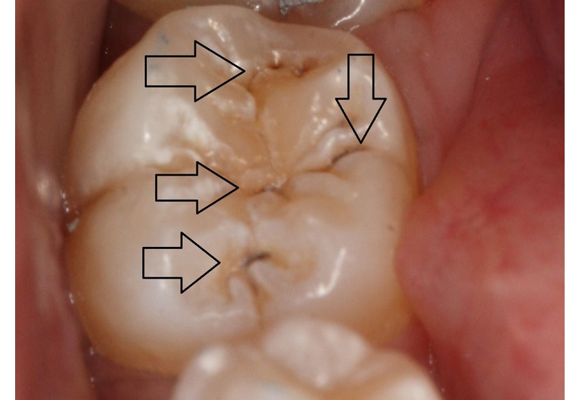 Trám bít hố rãnh phòng ngừa sâu răng tại các răng trong cùng
