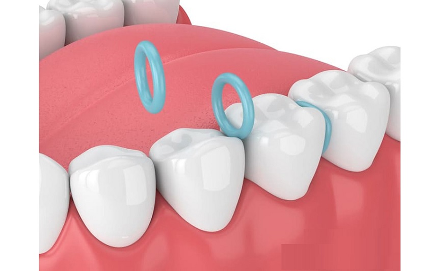 Thun tách kẽ Thun tách kẽ