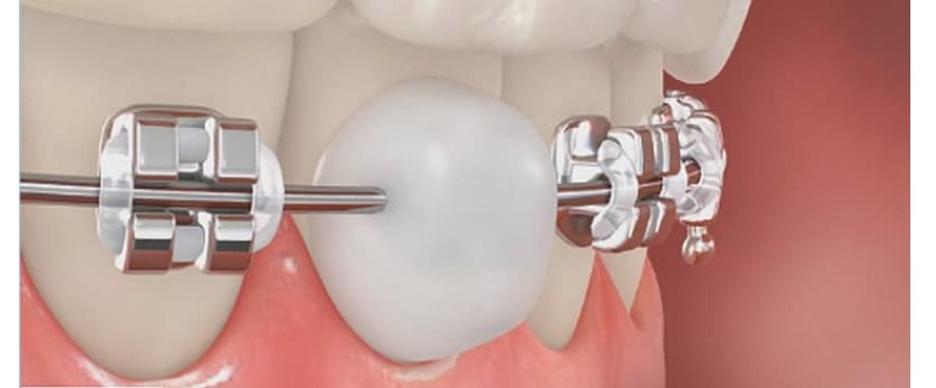 Sáp nha khoa tránh gây cọ xát vào nướu và má Sáp nha khoa tránh gây cọ xát vào nướu và má