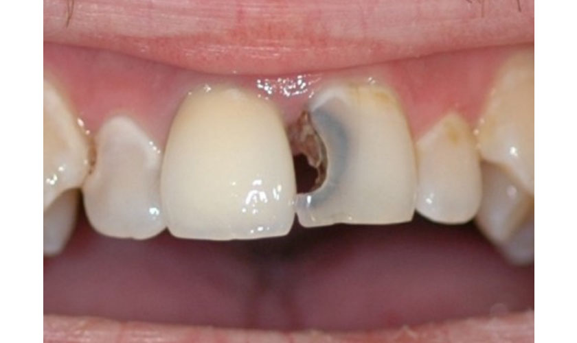  Răng cửa bị sâu đen phải làm sao - Cách chữa trị sâu đen trên răng cửa