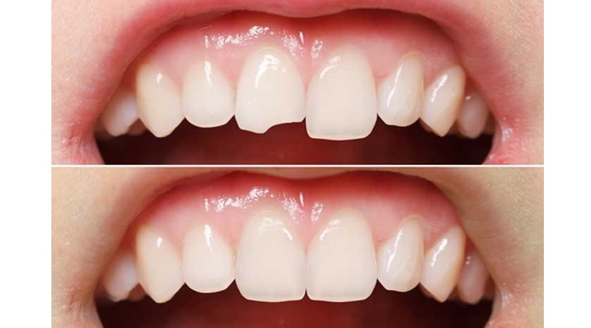 Trám răng cửa mang lại tính thẩm mỹ cao vì có màu sắc tương tự răng thật