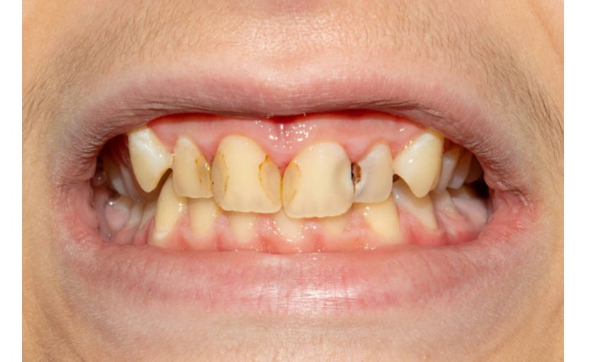 Nên lựa chọn trám răng hay bọc răng sứ cho răng cửa bị sâu?