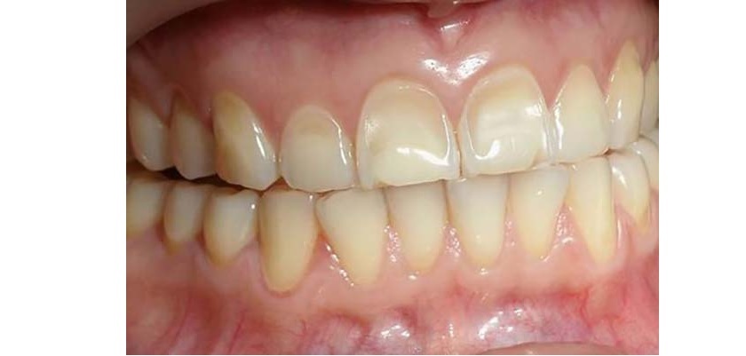 Trường hợp nào sẽ được chỉ định bọc răng sứ Cercon?