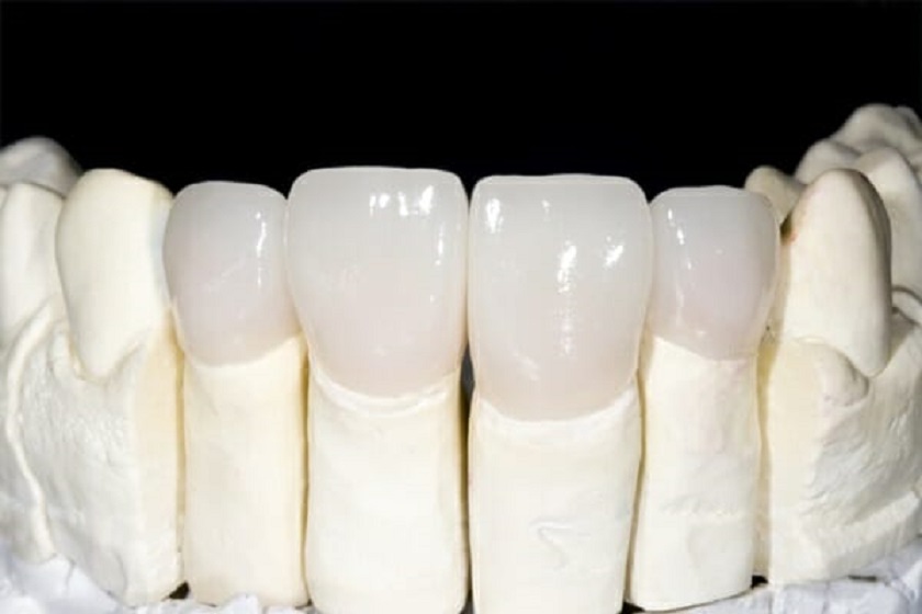 Răng Cercon có 2 loại là răng Cercon và Cercon HT