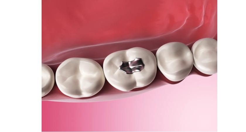 Trám răng phòng ngừa sâu răng Trám răng phòng ngừa sâu răng