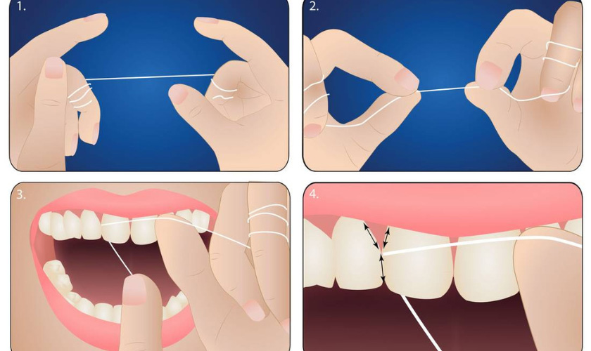 Phân loại chỉ nha khoa