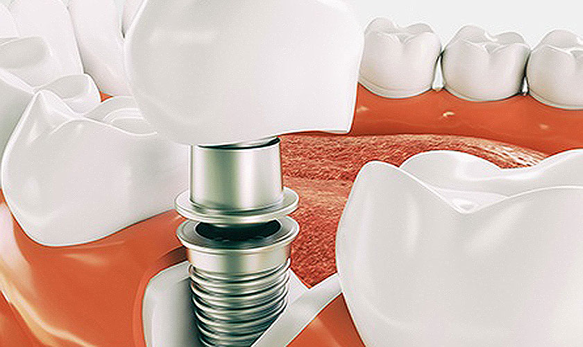 Quy trình trồng răng Implant chỉ mất 3 – 6 tháng Quy trình trồng răng Implant chỉ mất 3 – 6 tháng