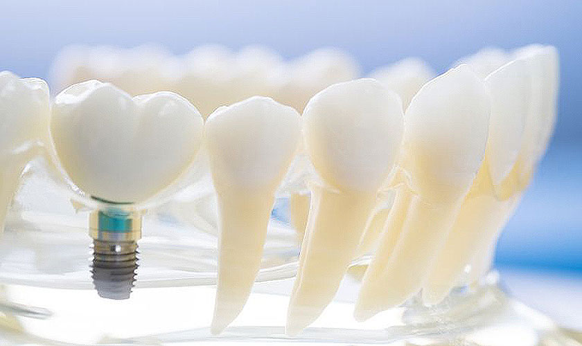 Sau khi cấy ghép Implant cần chăm sóc thật kỹ lưỡng Sau khi cấy ghép Implant cần chăm sóc thật kỹ lưỡng