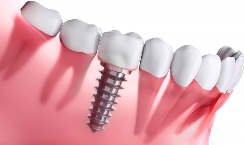 Trồng răng Implant bao nhiêu tiền cho một liệu trình?