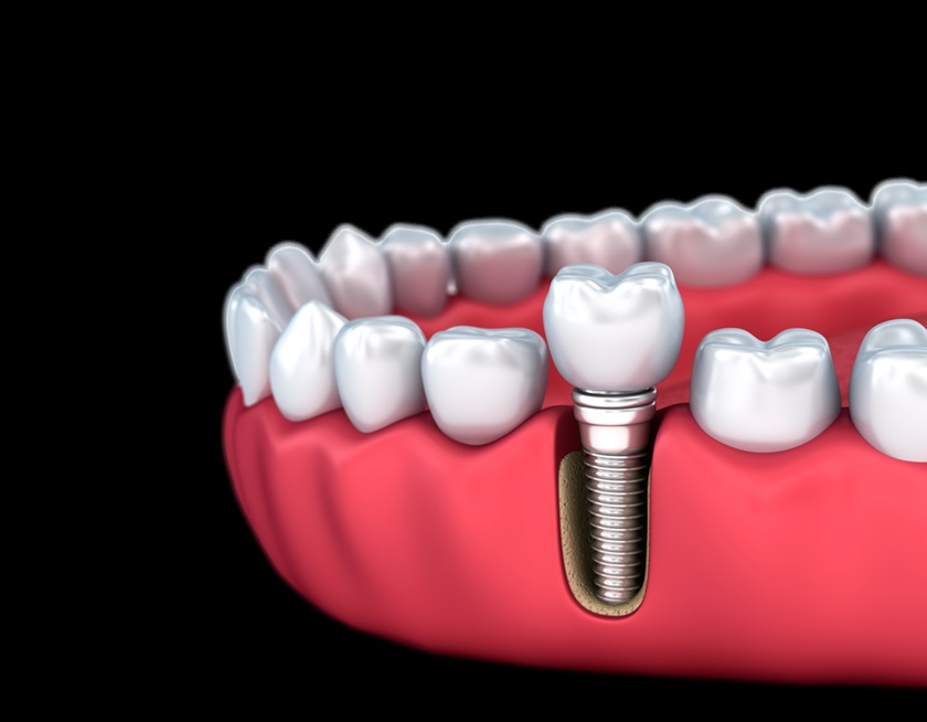 Giá trồng răng Implant phụ thuộc vào nhiều yếu tố