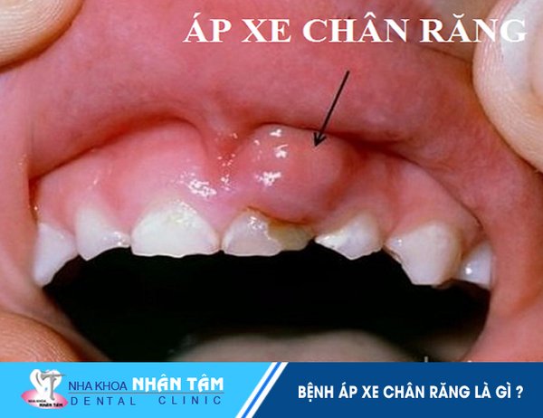 Bệnh áp xe chân răng là gì?