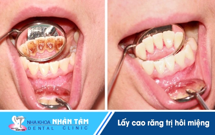 Lấy cao răng trị hôi miệng
